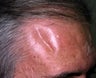 Liquid Injectable Silicone