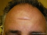 Forehead scar revision with simple excision