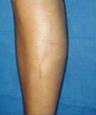 Scar revision of leg