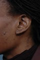 Keloid Removal