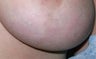 Breast implant scar removal