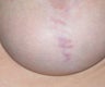 Laser for breast implant scar
