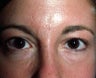 Liquid Injectable Silicone