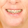 Scar Revision - Lower Lip