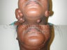Keloid Removal