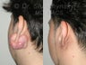 Keloid Removal