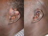 Keloid Removal