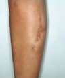 Scar revision of leg