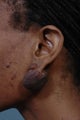 Keloid Removal