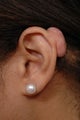 Keloid Removal