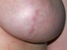 Breast implant scar removal