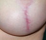 Laser for breast implant scar