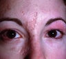 Liquid Injectable Silicone