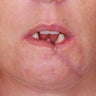 Scar Revision - Lower Lip