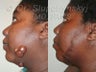 Keloid Removal