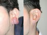 Keloid Removal