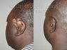 Keloid Removal