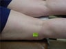 spider vein sclerotherapy