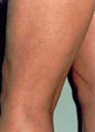 Sclerotherapy