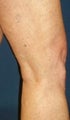 Sclerotherapy