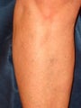 Sclerotherapy on Leg
