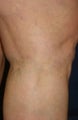 Leg Vein Sclerotherapy