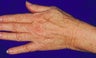 Sclerotherapy for hands