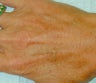 Sclerotherapy treatment for hand