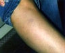 Sclerotherapy