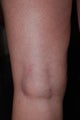 Sclerotherapy