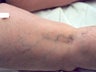 spider vein sclerotherapy
