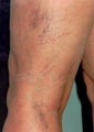 Sclerotherapy