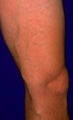 Sclerotherapy
