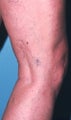 Sclerotherapy