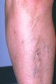 Sclerotherapy on Leg