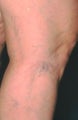 Leg Vein Sclerotherapy