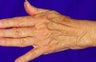 Sclerotherapy for hands