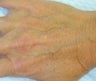 Sclerotherapy treatment for hand