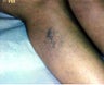 Sclerotherapy