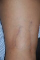 Sclerotherapy