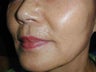 Sculptra