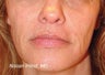 Sculptra