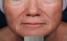 Fillers - Sculptra