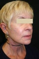 Sculptra