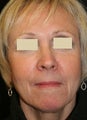 Sculptra Liquid Lift