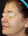 Sculptra Liquid Lift