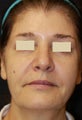 Sculptra