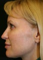 Sculptra