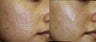 Acne scar