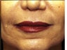 Sculptra